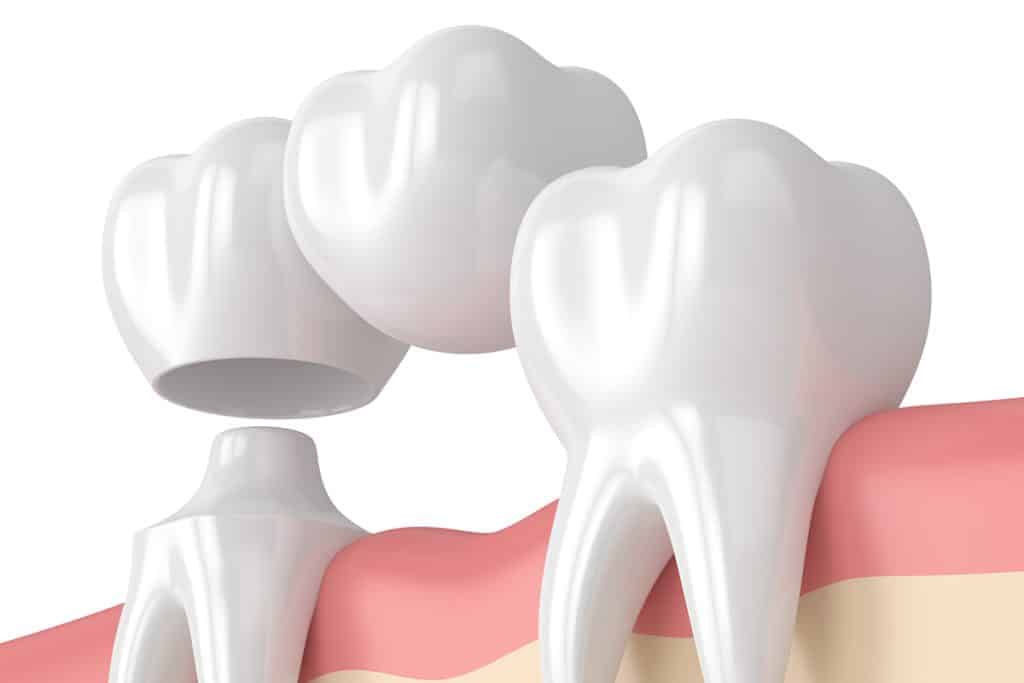 can-a-dental-bridge-be-removed-recemented