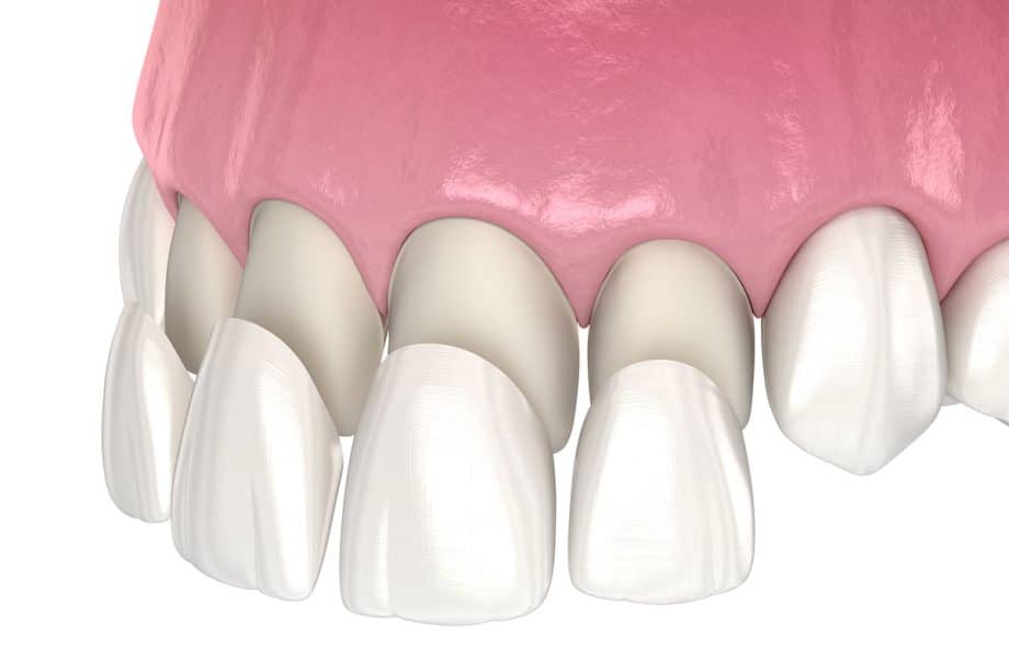 How Long Do Dental Veneers Last?