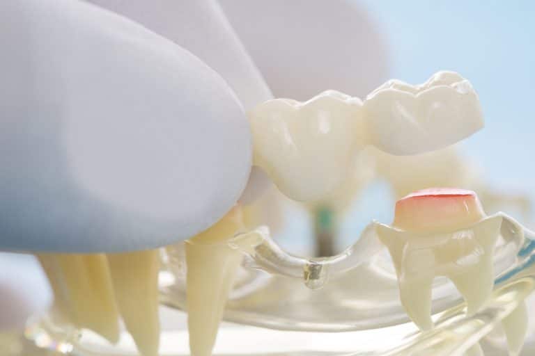 how-long-does-it-take-to-get-used-to-a-dental-bridge