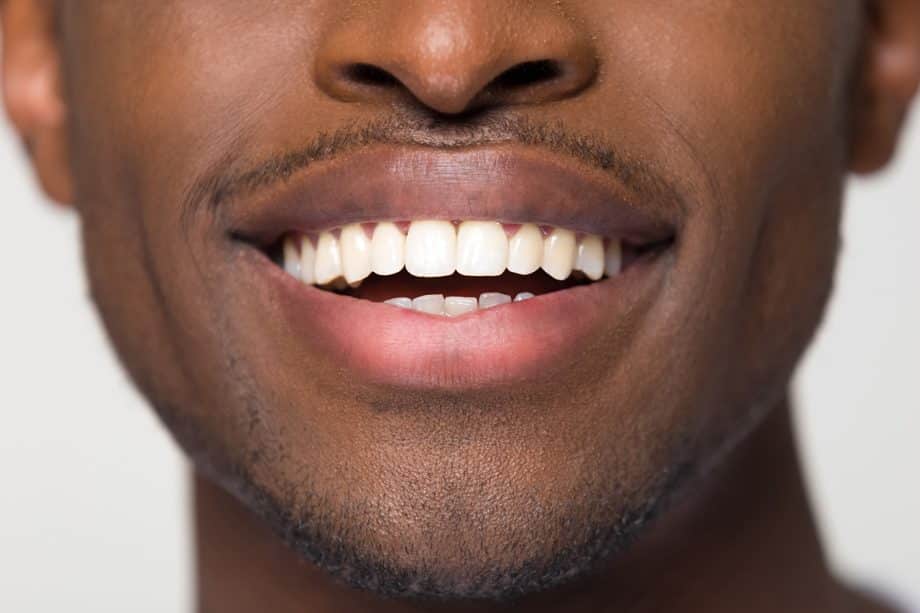 How Long Does Professional Teeth Whitening Last?